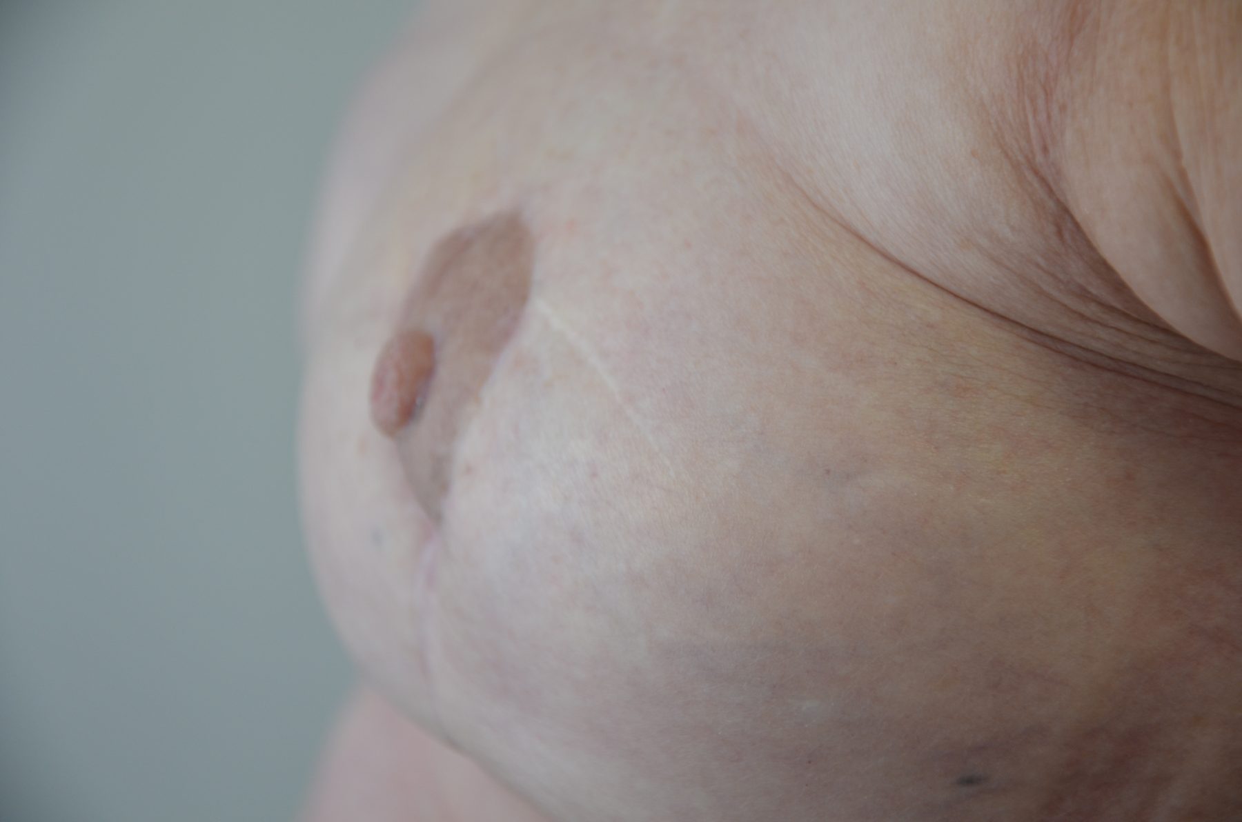 Aréole recolorée par dermopigmentation sur un sein reconstruit, vue de profil.